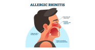 Allergic Rhinitis Symptoms Causes Types And Treatments