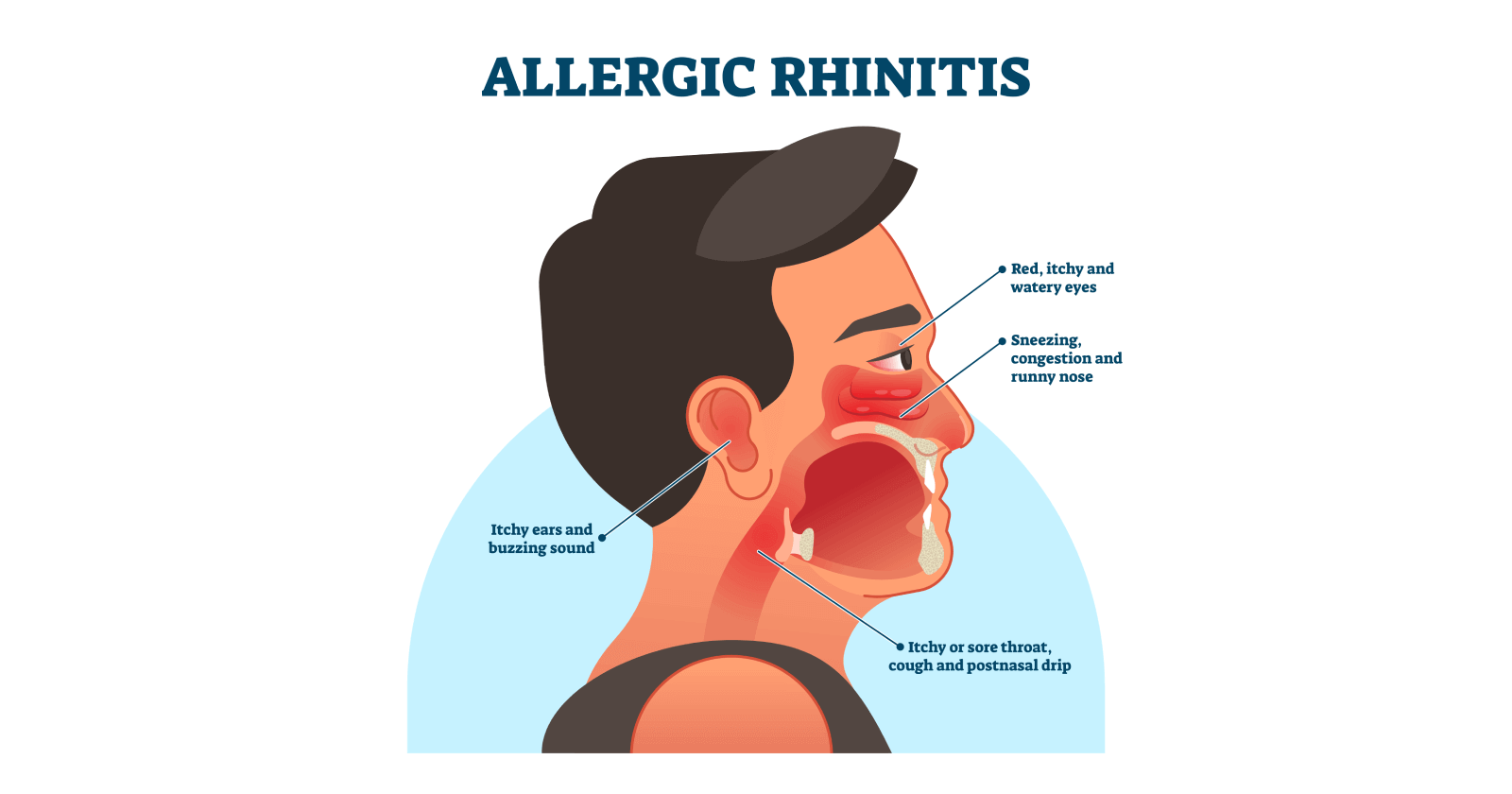 Overview of Allergic Rhinitis: Causes, symptoms, types, stages and treatment