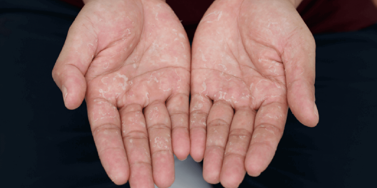 Dyshidrotic Eczema Dyshidrosis Overviewsymptoms Causes And Treatment