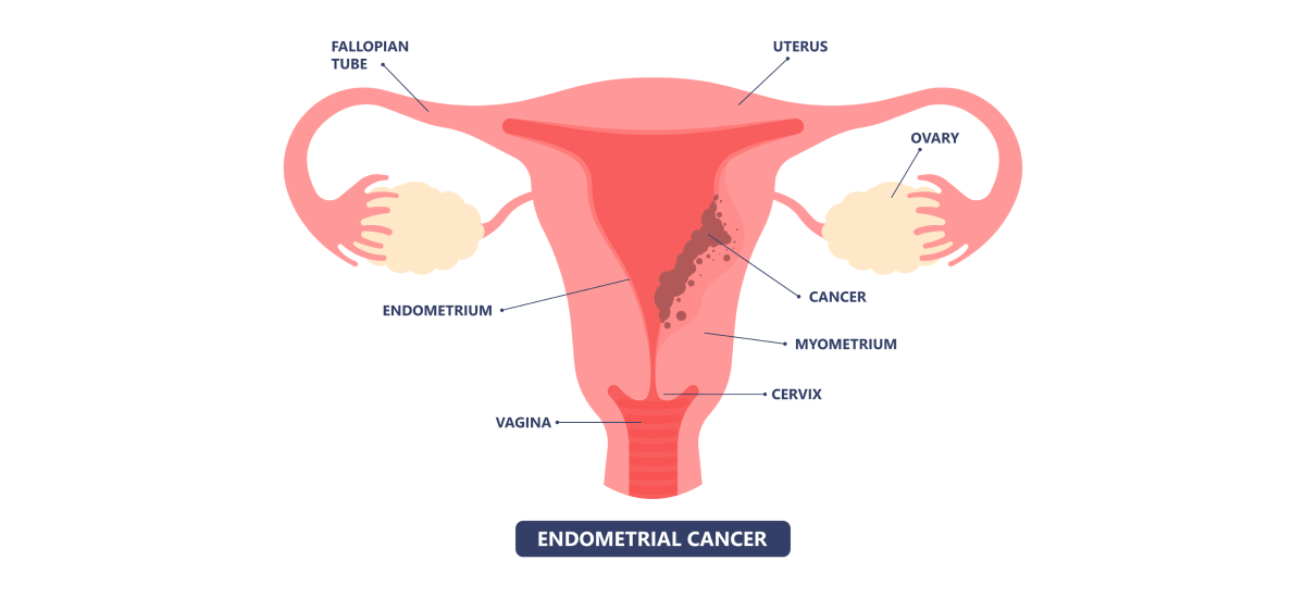 Endometrial Cancer Symptoms Causes Types And Treatments 0911