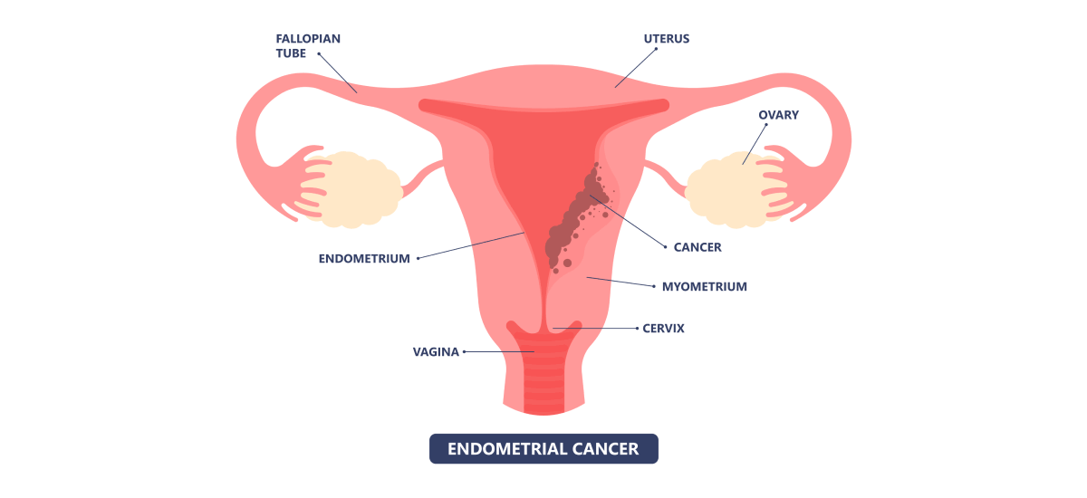 Everything You Need To Know About Endometrial (Uterine) Cancer