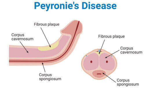 Curvature of the Penis (Peyronie's Disease) Guide: Causes, Symptoms and  Treatment Options