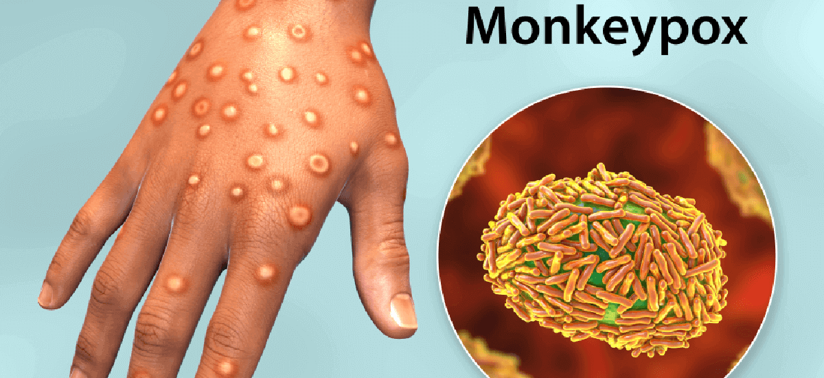 What is Monkeypox?