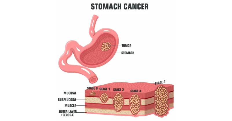 Stomach Cancer