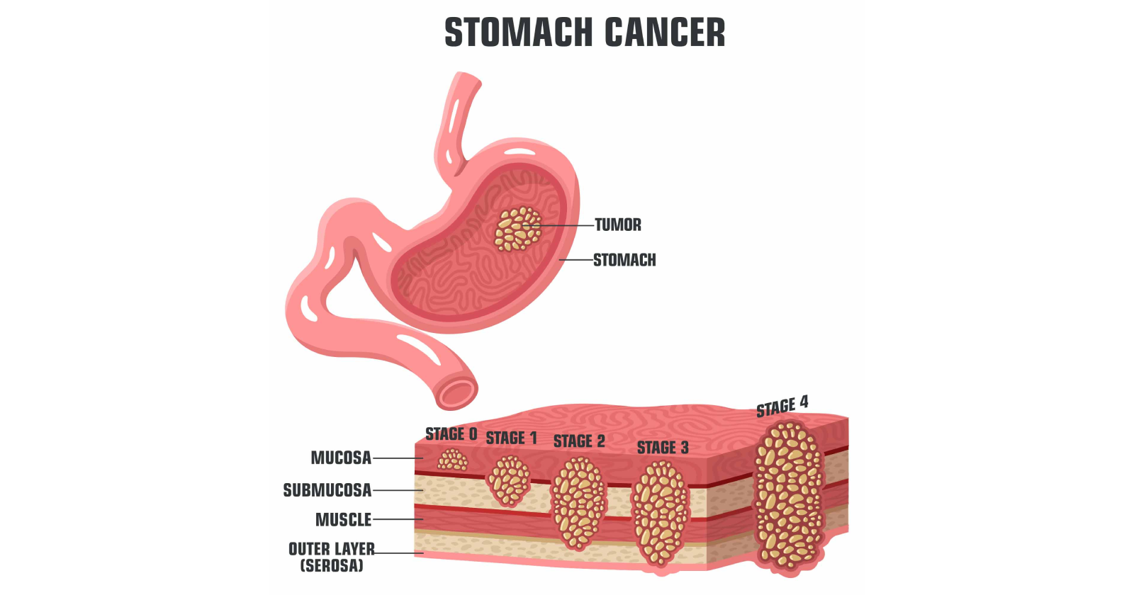 Stomach Cancer Symptoms Types Stages Prevention And Treatment