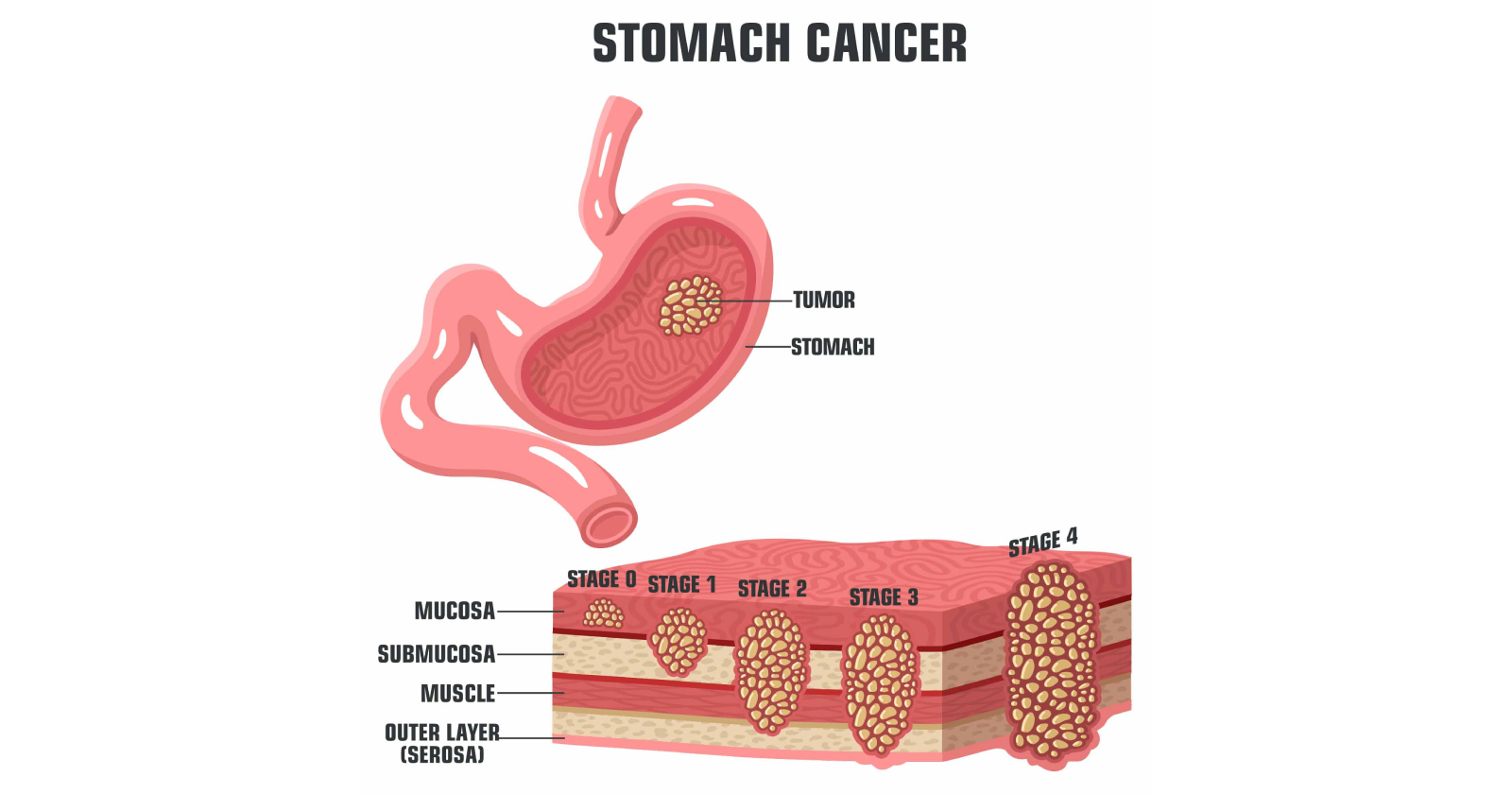 Overview of Stomach Cancer: Causes, symptoms, and treatment