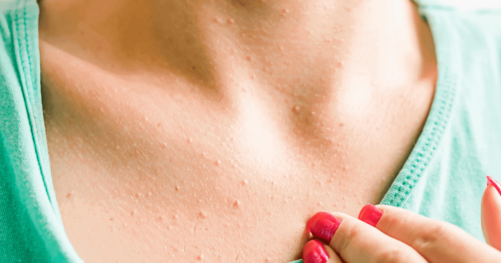 Itchiness of Breast - Causes and Treatment 