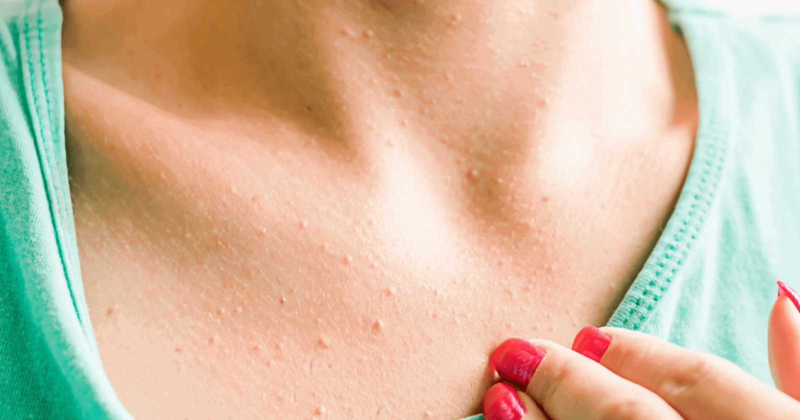 Breast Rash Meaning Causes Symptoms And Treatment