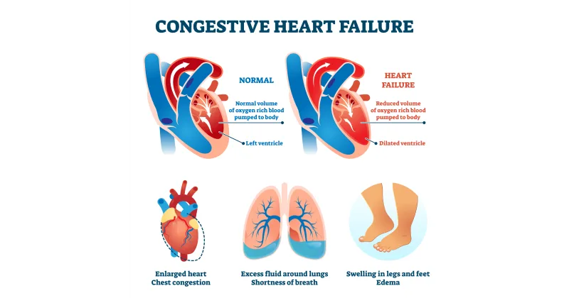 Understanding Congestive Heart Failure
