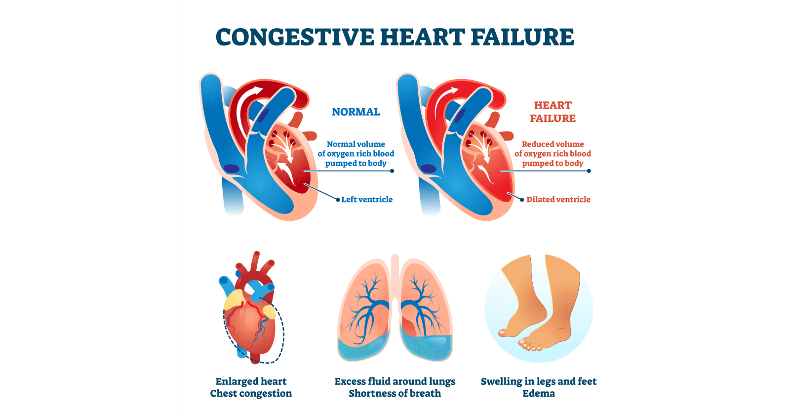 congestive-heart-failure-symptoms-causes-types-treatments