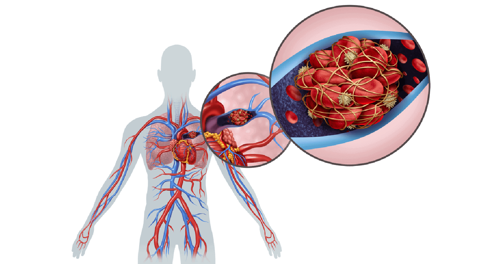 signs-and-symptoms-you-have-a-blood-clot-and-might-not-even-know-it