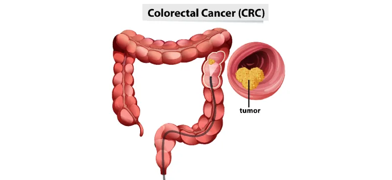 Colorectal Cancer