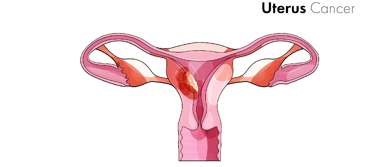 uterine-cancer-symptoms-causes-stages-and-treatments