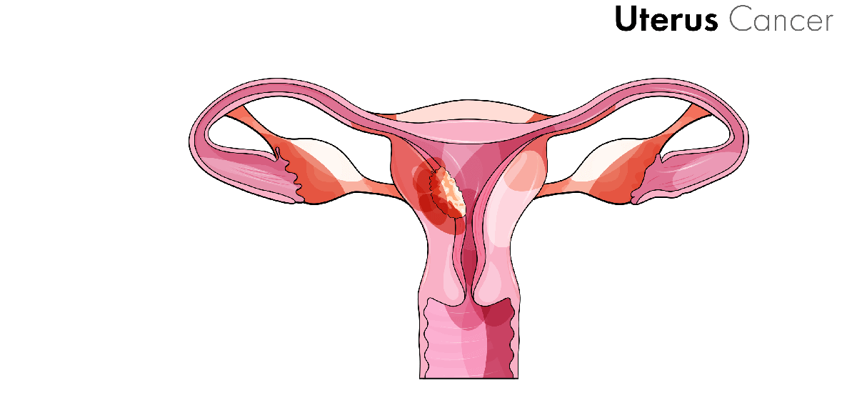 Uterine Cancer: Symptoms, causes, prevention and treatment