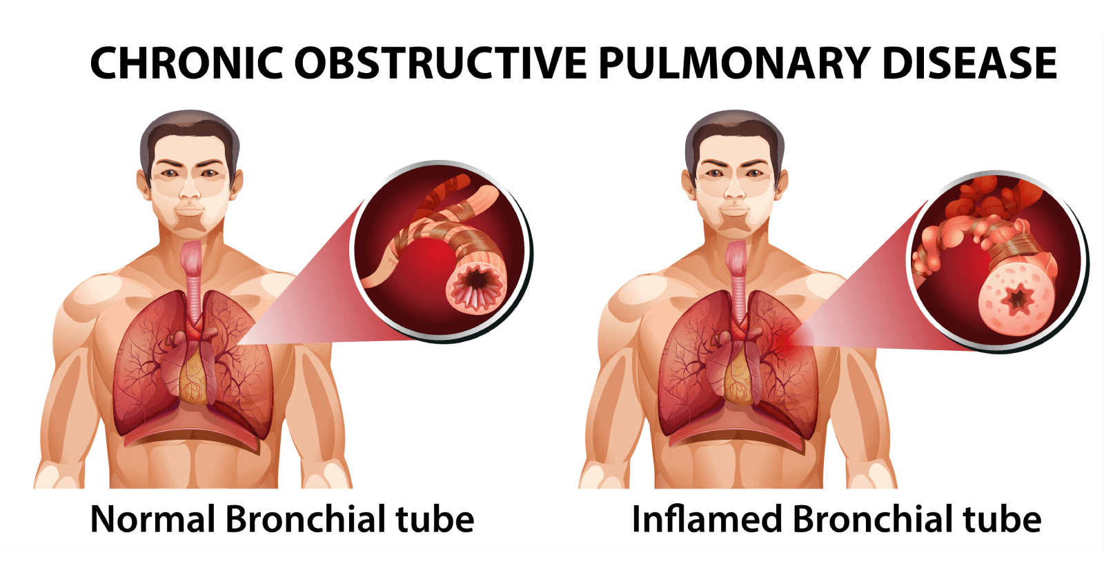 chronic-obstructive-pulmonary-disease-copd-symptoms-causes