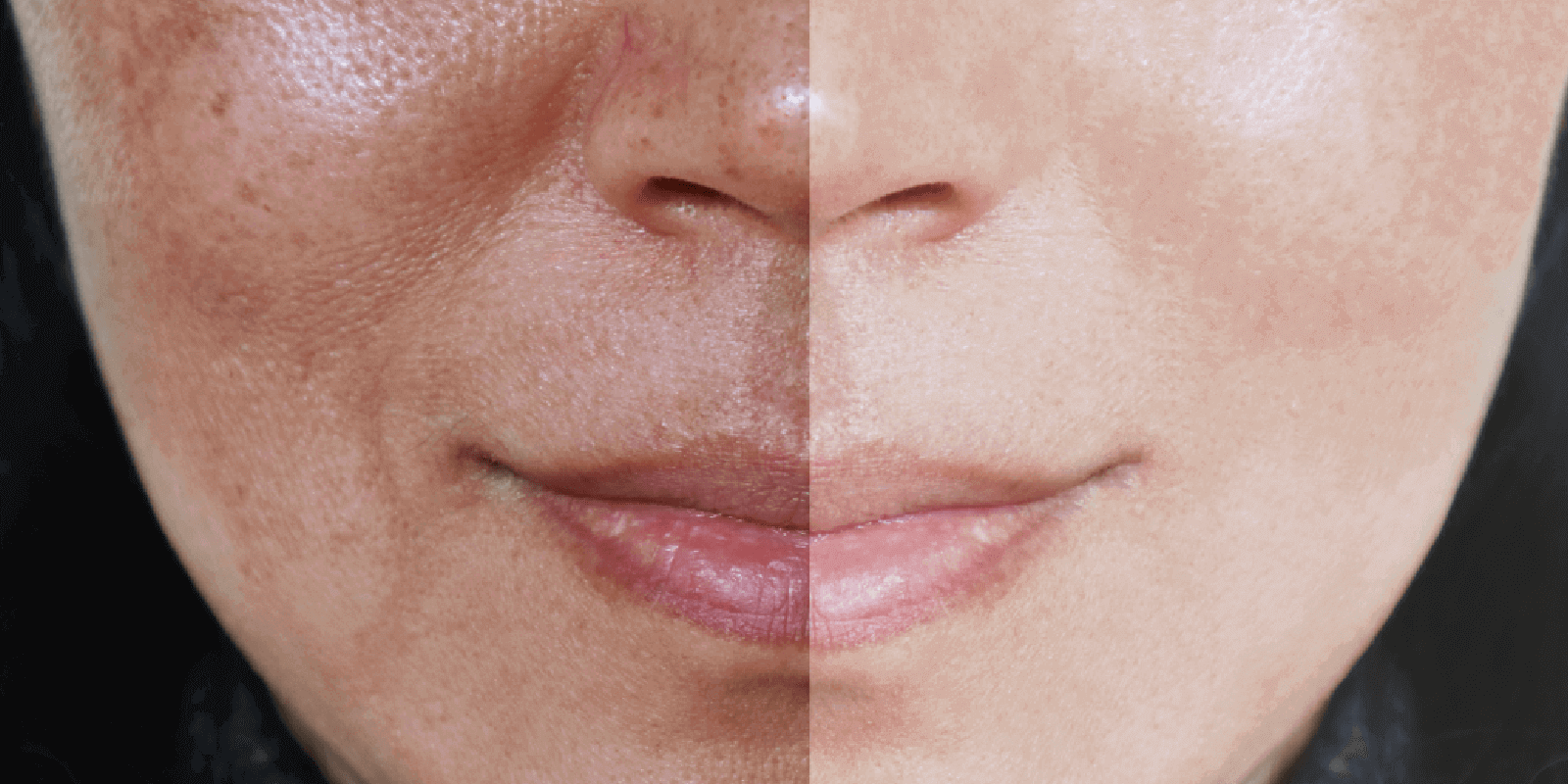 Overview of Melasma: Symptoms, diagnosis, and treatments