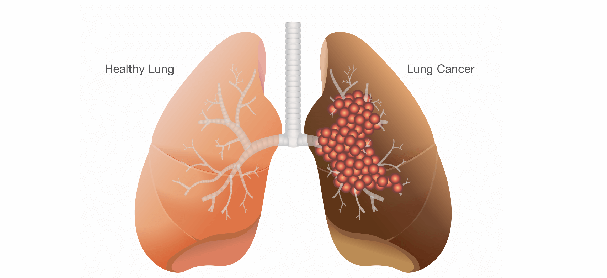 Lung Cancer: Causes, types, symptoms, and treatment