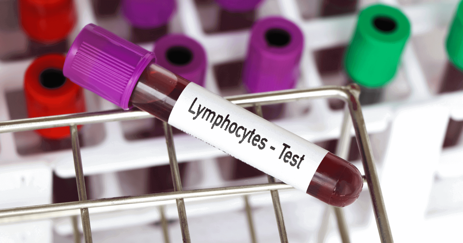 Lymphocytosis (High Lymphocyte Count) Symptoms, Causes & Diagnosis