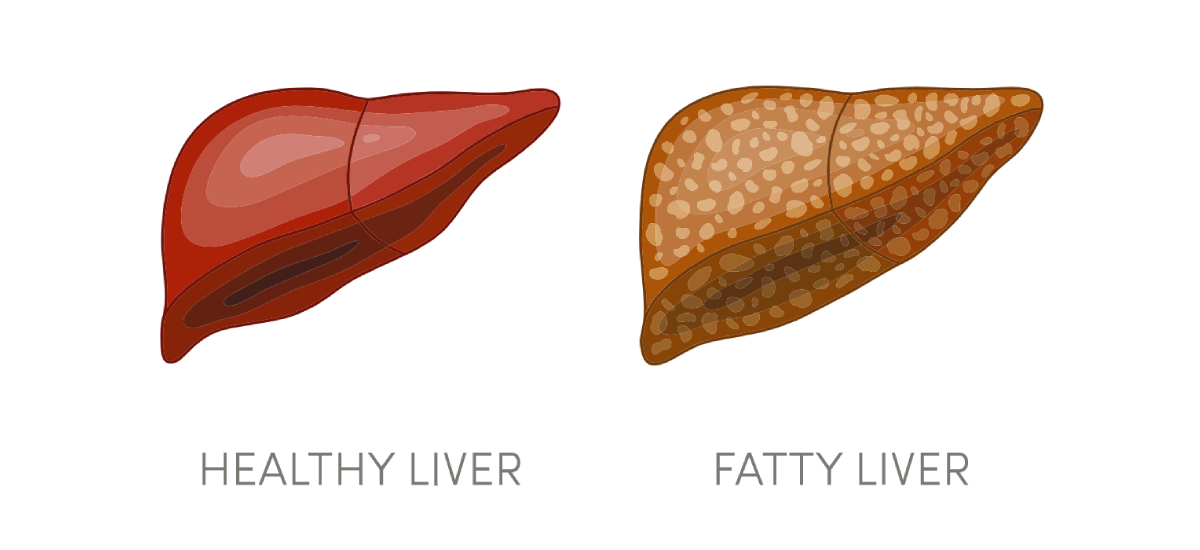Fatty Liver Types, Stages, Symptoms, Causes and Treatment