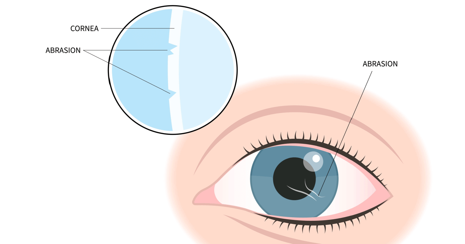 first-aid-guide-corneal-abrasion-scratch