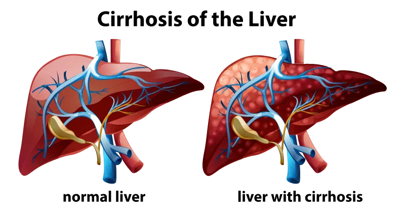 Liver Cirrhosis: Symptoms, Causes, Prevention and Treatments