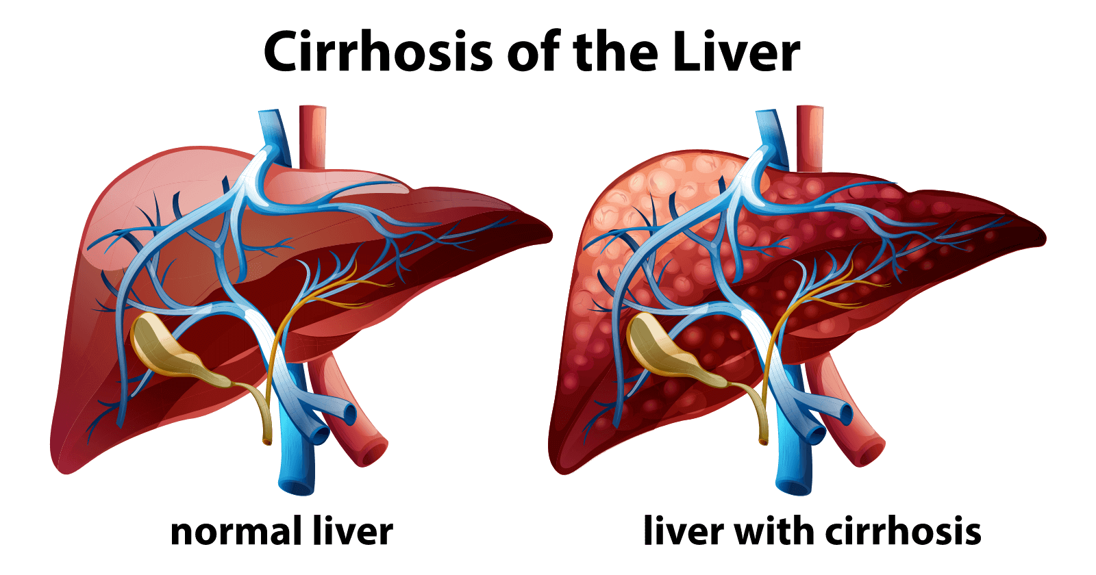 Liver Cirrhosis Symptoms Causes Prevention And Treatments