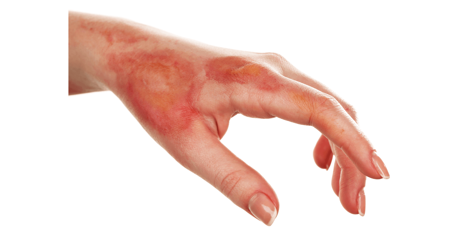 First Aid with Burns: Proper Response & Treatment