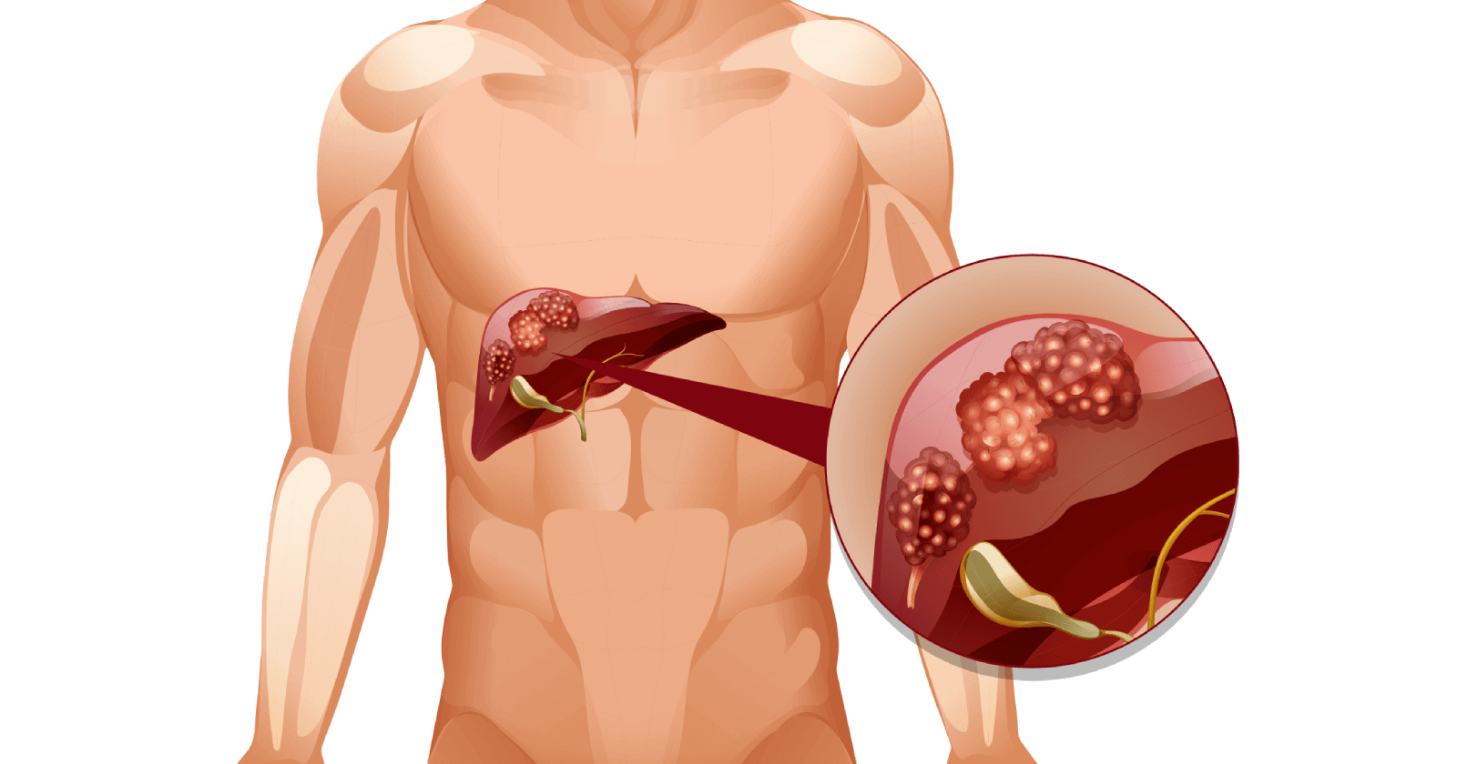 Understanding Liver Cancer: Types, symptoms, causes, diagnosis, treatment & prevention