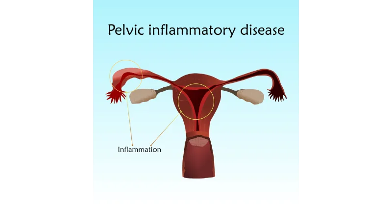 Pelvic Inflammatory Disease