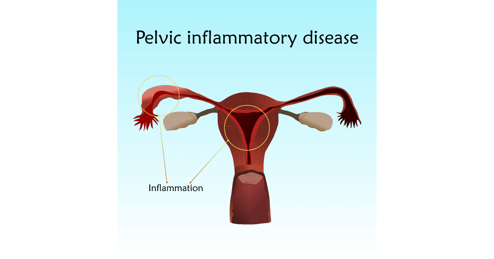 Understanding Pelvic Inflammatory Disease: Symptoms, causes and treatments