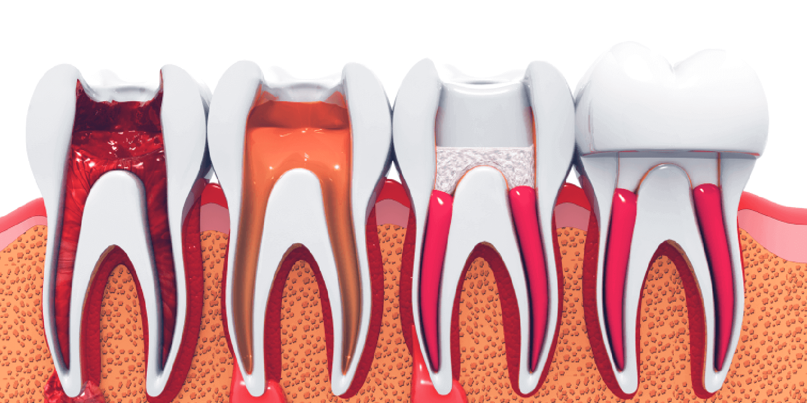 Root Canal What Is It, Diagnosis, Treatment & Side Effects