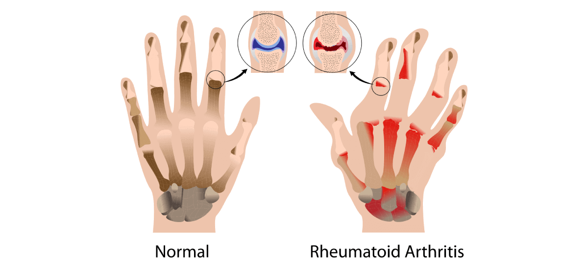 Rheumatoid Arthritis Symptoms, Causes, Prevention & Treatments