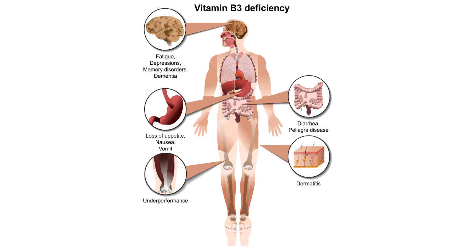 Vitamin B3 Deficiency Symptoms, Causes, Treatment & Prevention