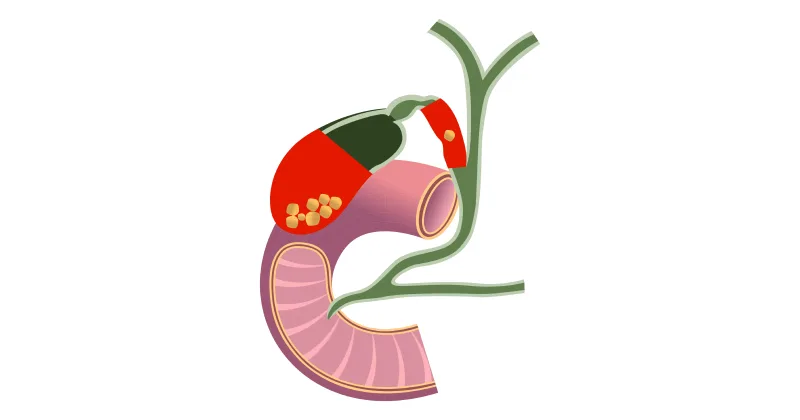 Gallbladder Cancer