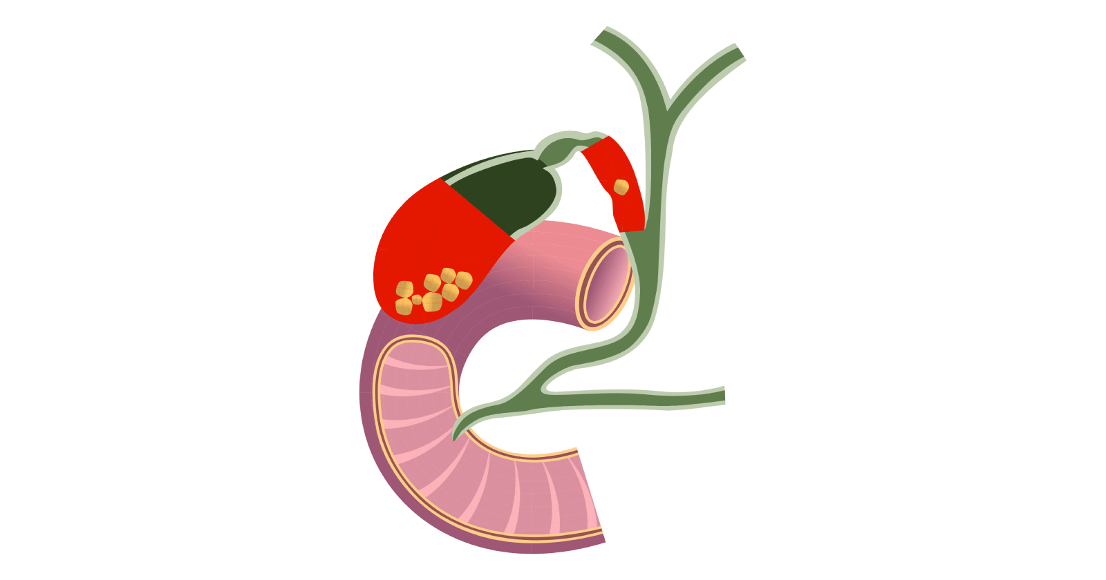 gallbladder-cancer-types-symptoms-causes-stages-treatment