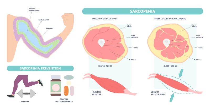 Sarcopenia Disease