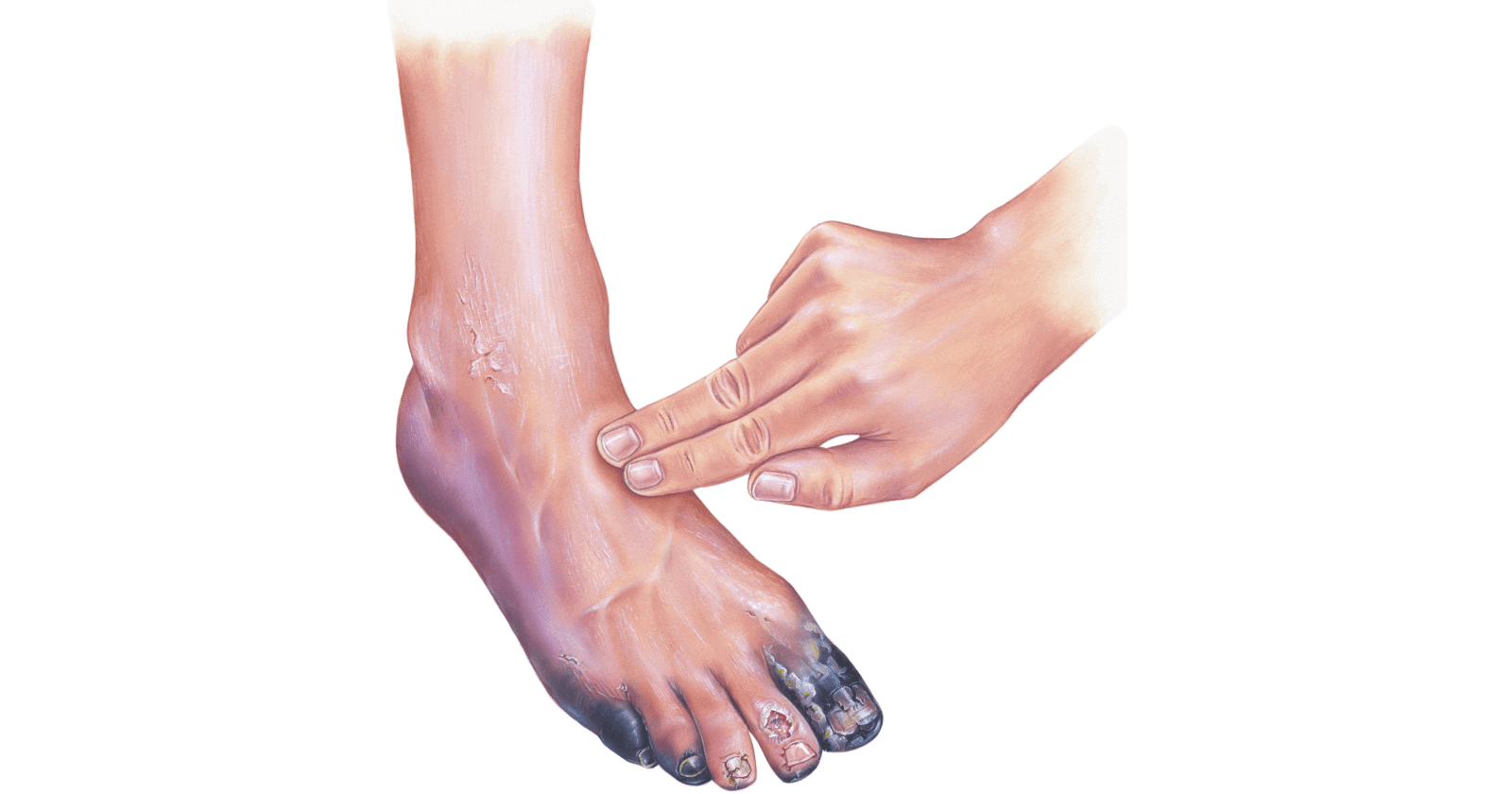 Gangrene Symptoms, Causes, Prevention and Treatments