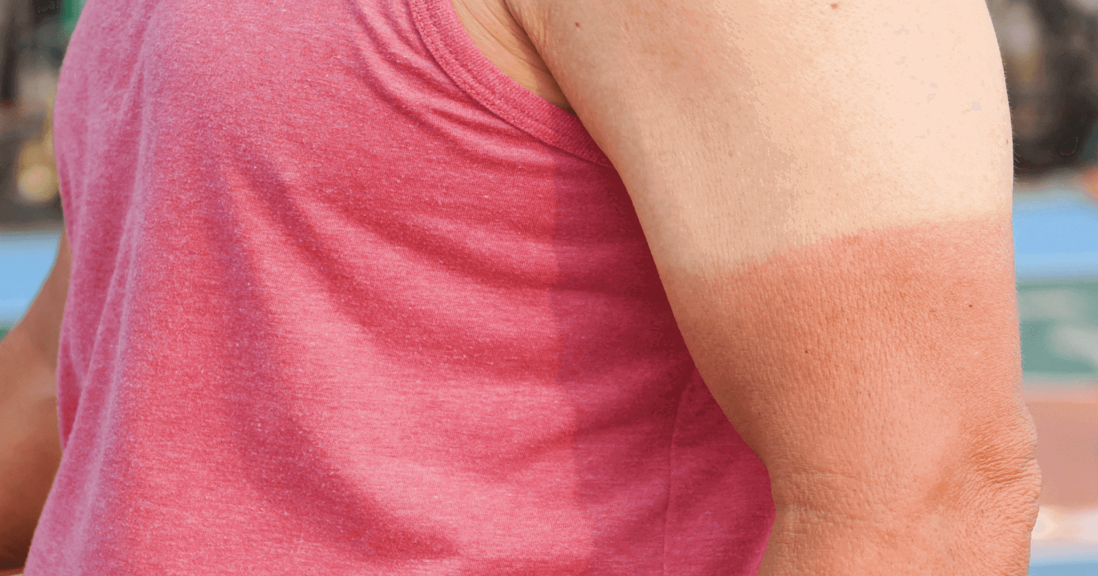 first aid guide for sunburn