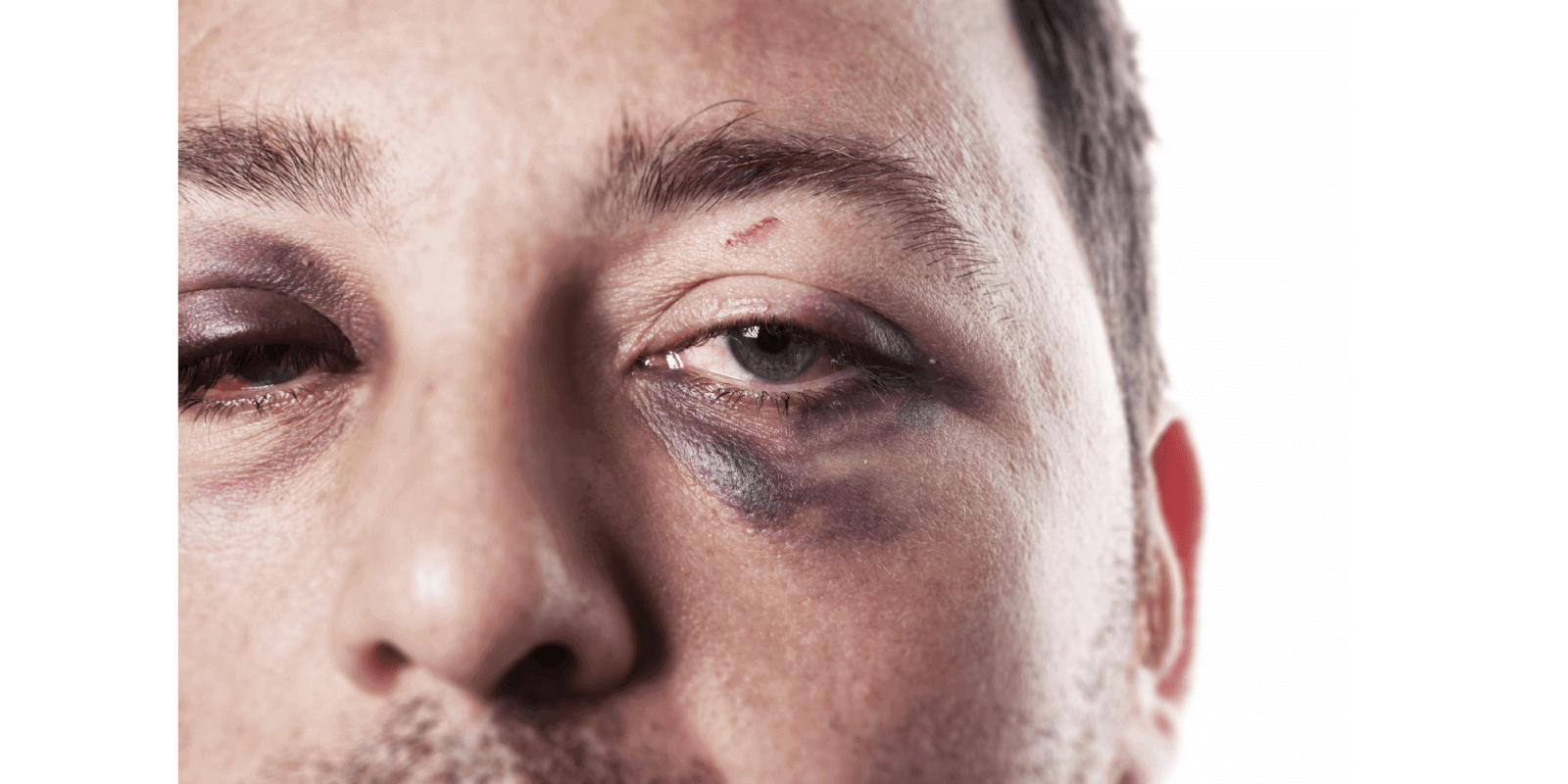 First aid for Black Eyes: Symptoms & Best Home Remedies