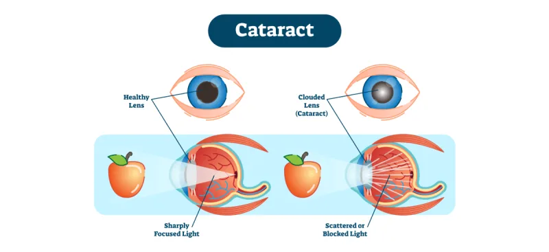 Cataract