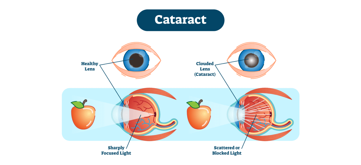 What is Cataract: Causes, Types, Symptoms and Treatment