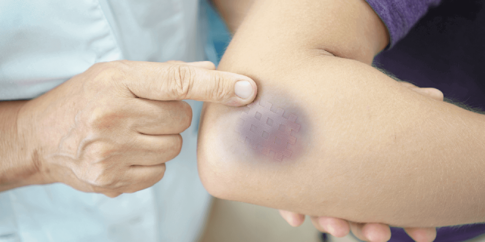 First Aid Guide: Dealing with Bruising