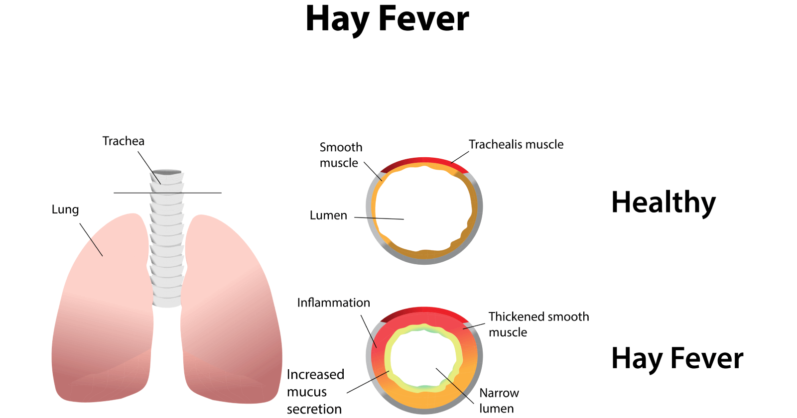 Hay fever clearance