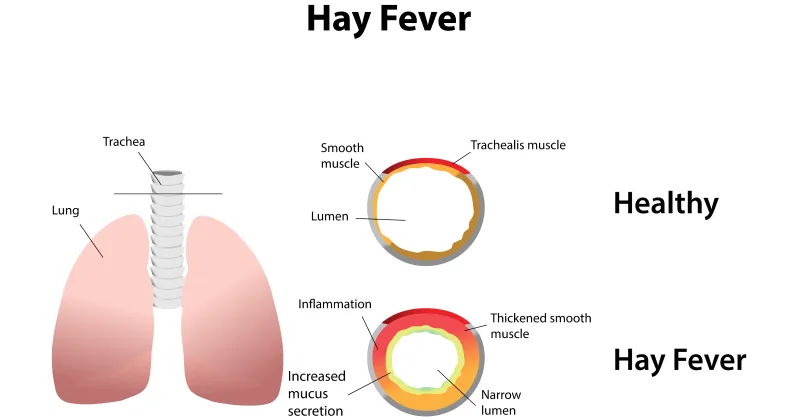 Hay Fever: Symptoms, Causes, Prevention and Treatments