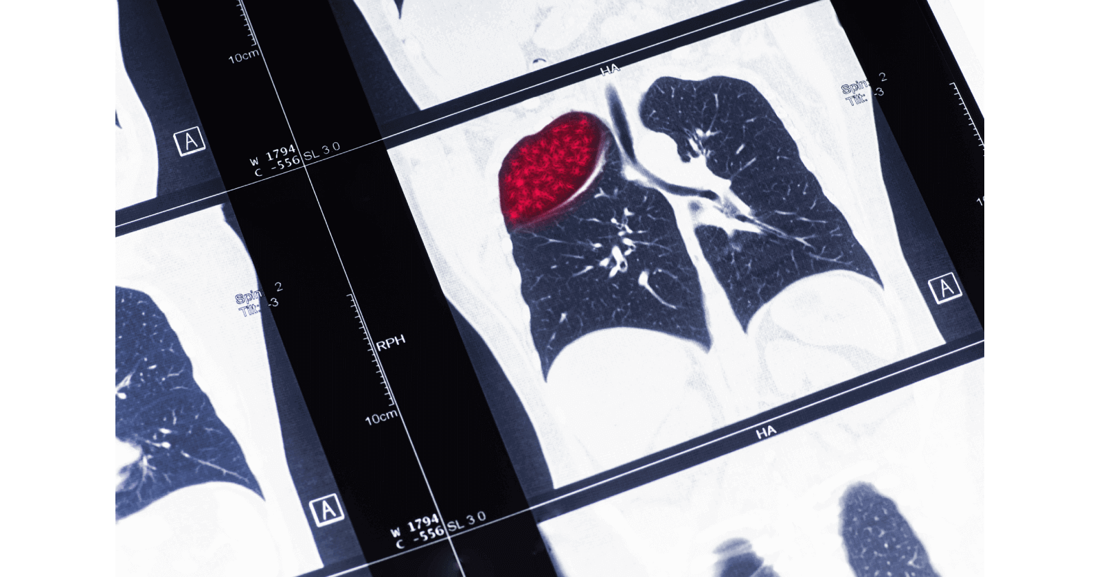 Overview of Lung Tumour: Types, causes, symptoms and treatment