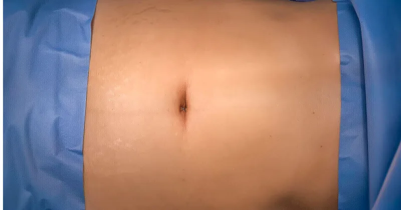 abdominal-surgery