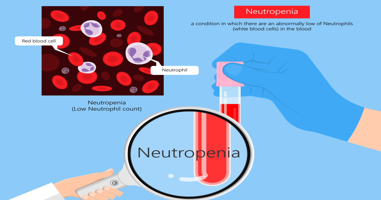 Neutropenia (low Neutrophil Count): Types, Symptoms & Causes