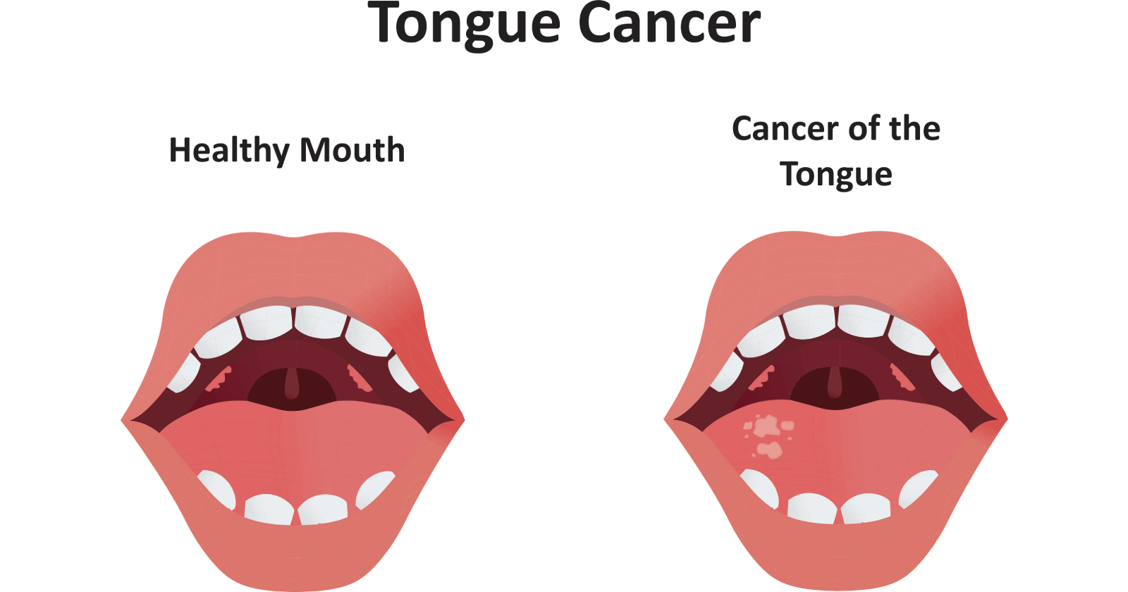Tongue Cancer Symptoms Stages Causes Prevention And Treatment