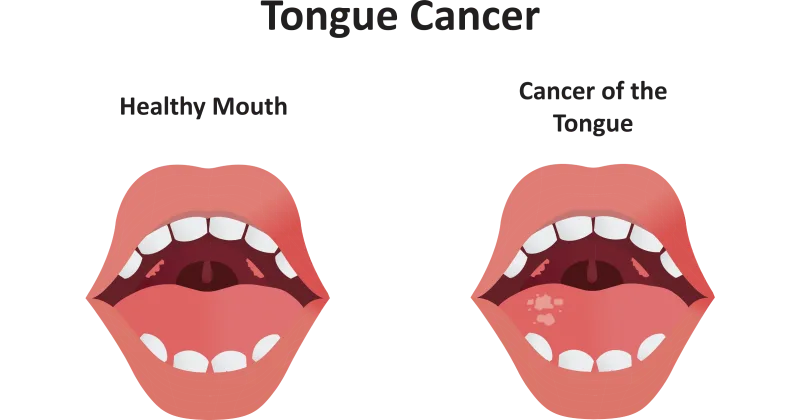 Tongue Cancer