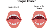 Tongue Cancer Symptoms Stages Causes Prevention And Treatment